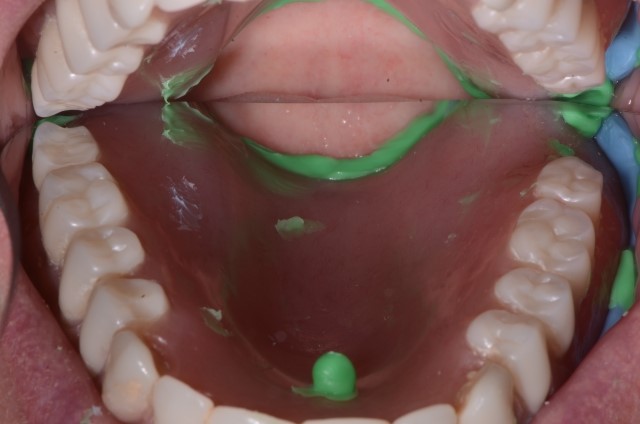 Ivoclar Dentures Shell WY 82441